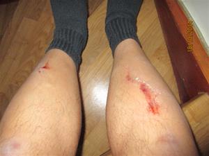 Mina trasiga ben efter fallet i betongtrappen från ytterdörren och ner till marknivå. IMG_0332
